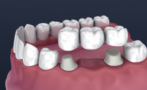 dental bridge