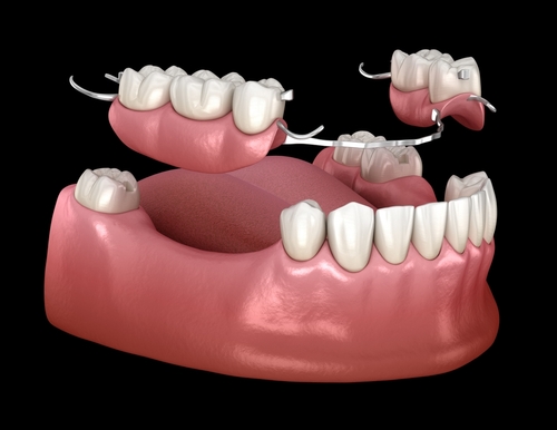 partial dentures